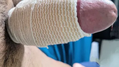 Guevo fracturado y recuperado esperando masaje